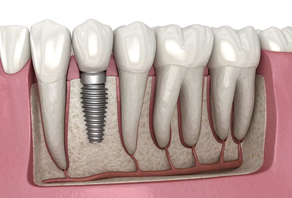 Implants in Agoura Hills
