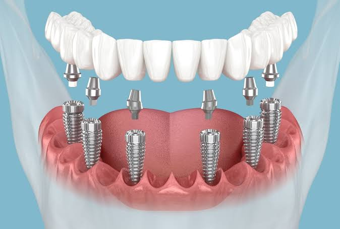 Implants b